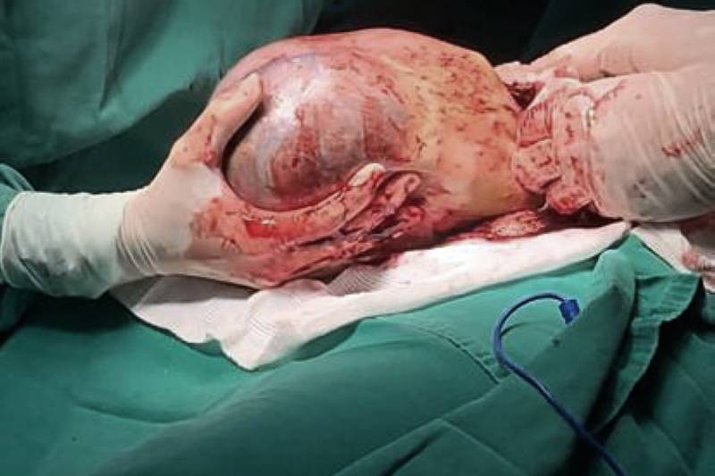 Em fenômeno raro, Santa Casa registra nascimento de gêmeo dentro da bolsa amniótica da mãe